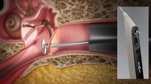 TymCure solution for tympanic membrane perforations