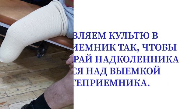 НАДЕВАНИЕ ШИНОКОЖАНОГО ПРОТЕЗА ГОЛЕНИ.