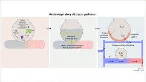Острый респираторный дистресс синдром - ОРДС: патогенез, причины, лечение | Медома | USMLE step 1