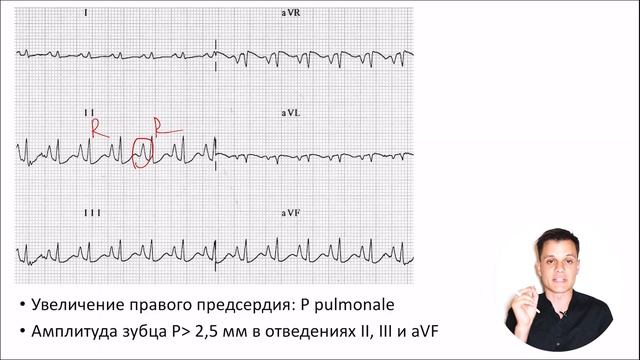 ЭКГ за 100 минут 6: Гипертрофия сердца на ЭКГ