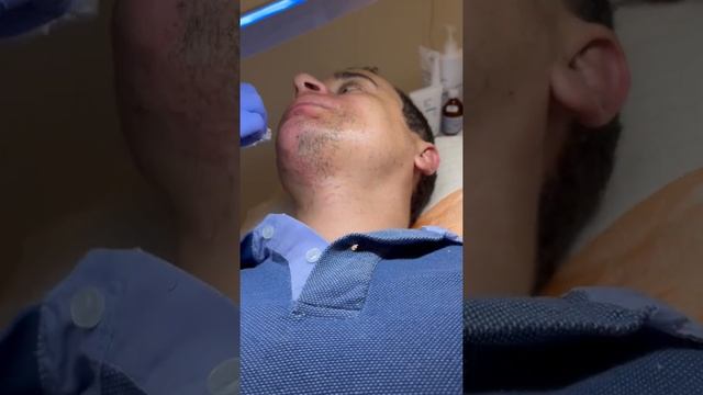 Электроэпиляция во всей её красе ( Мужская эпиляция удаление волос на лице ) #shorts смотреть онлайн