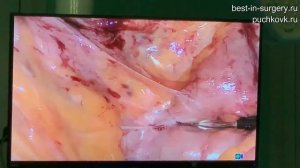 Хирургическое лечение спаечной болезни лапароскопическим доступом