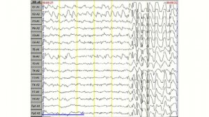 Затылочная эпилепсия