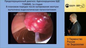 Эндоскопическая папиллэктомия. Тернистый путь к успеху