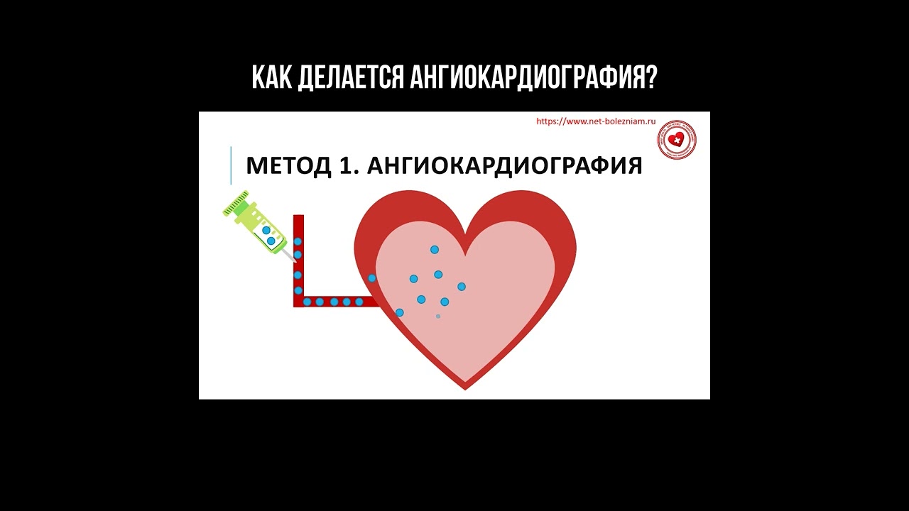 Как делается ангиокардиография? смотреть онлайн