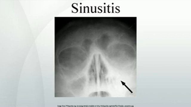 Sinusitis