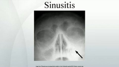 Sinusitis