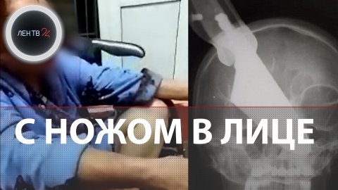 Выжила с ножом в лице | В Краснодарском крае врачи извлекли из носовой перегородки пациентки шеф-нож