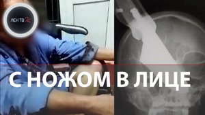 Выжила с ножом в лице | В Краснодарском крае врачи извлекли из носовой перегородки пациентки шеф-нож