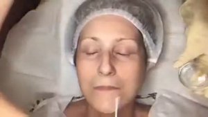 Миндальный пилинг Mediderma процедура проведения