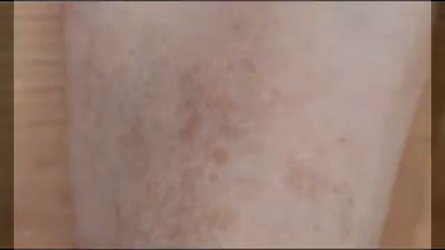 Пигментные пятна (на коже, теле)