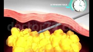 Лазерная липосакция в Тюмени