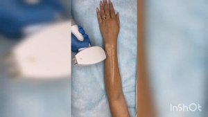 Лазерная эпиляция рук диодным лазером от Gelios