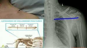 COLLAR/CLAVICLE BONE FRACTURE/CLAVICLE BONE टूट जाने पर क्या करें/BONE FRACTURE X RAY/X RAY कैसे कर