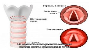 Что такое острый ларингит