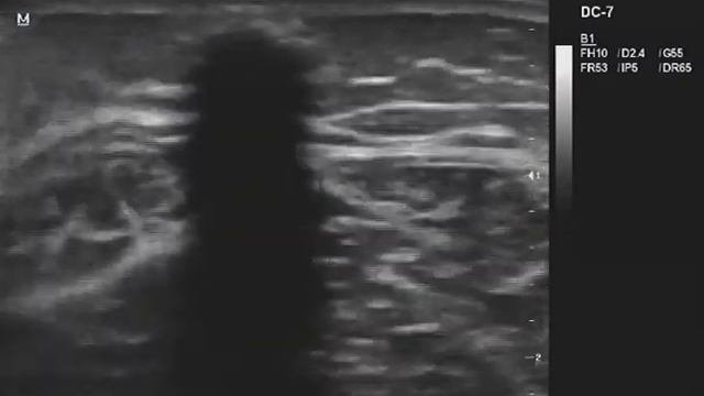 Объемное образование мягких тканей голени на УЗИ