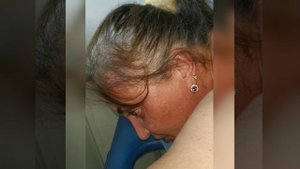 ставим пиявок на зону копчика, интервью пациентки, пиявки на крестце, 3 сеанс пиявок, снижение веса