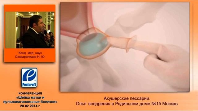 Акушерские пессарии Арабин Опыт применения в 15 роддоме гМосквы кмн Сакварелидзе НЮ