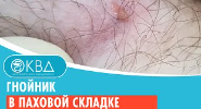 ? Гнойник в паховой складке. Клинический случай №716