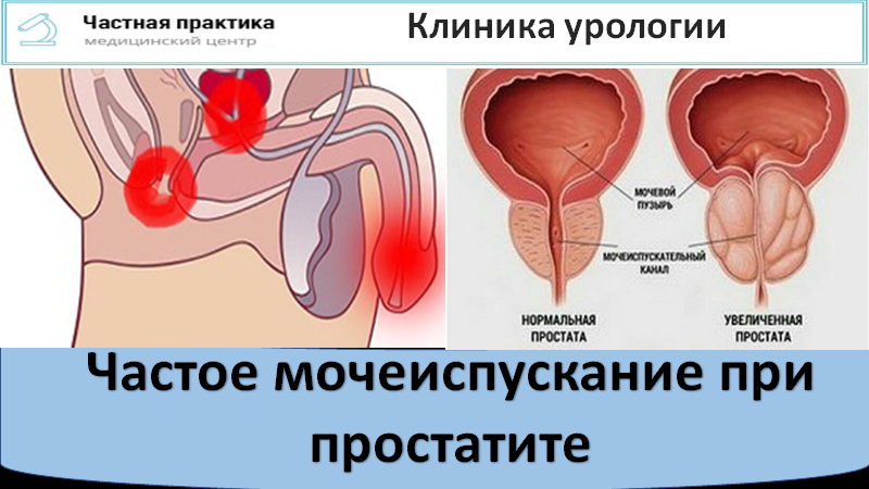 Частое мочеиспускание у мужчин лечение. Мочеиспускание при простатите. Простатит частые мочеиспускания. Воспаление простаты у мужчин. Простатит у мужчин статистика.