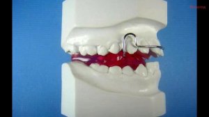 Бионатор Балтерса (Balters) типа 2 - 3.Ортодонтический аппарат.