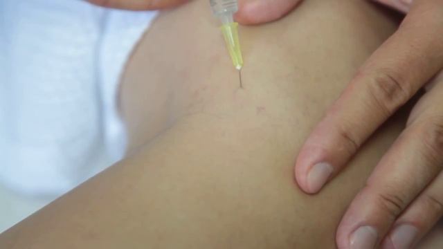 Склеротерапия: как происходит удаление сосудистых звёздочек - GMTClinic