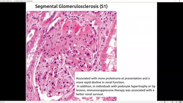 Basics of Renal Pathology : IgA Nephropathy