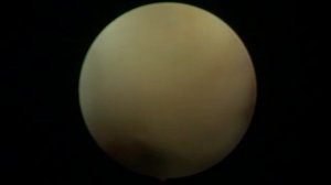 Рецидив грыжи L5-S1. Трансфораминальная секвестрэктомия.