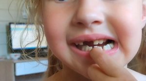 У СОНИ качаются молочные зубы. Скоро выпадут млочные зубы. Удалять или ждать пока выпадут сами?