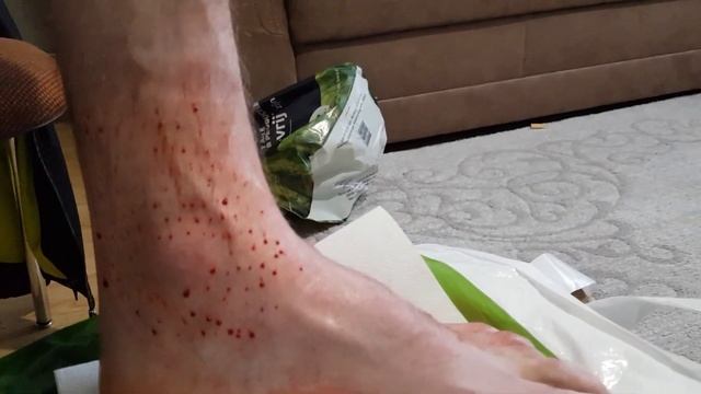 Делаем хиджаму на Растяжение стопы. hijama pied entorse mengobati dislokasi kaki
