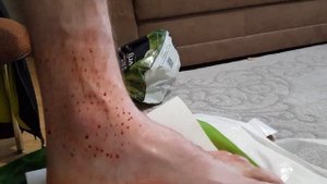 Делаем хиджаму на Растяжение стопы. hijama pied entorse mengobati dislokasi kaki