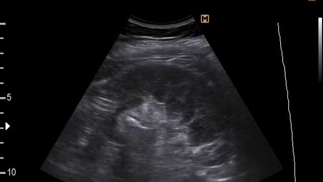 Конкремент почки (17-5-17) смотреть онлайн