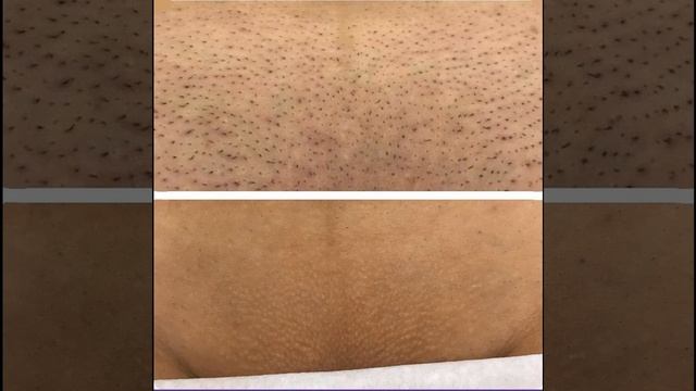 Электроэпиля́ция. 89614961207 приём записи смотреть онлайн