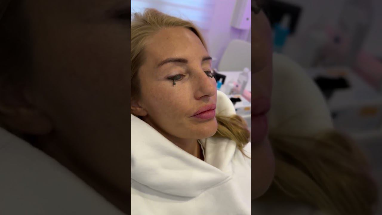 Один раз сделал - год абонемент в дом Боли. Рекомендасьен #тату #лазер #удалениетату