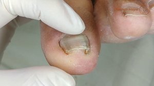 1 year later | Ingrown toenail & granuloma (3rd part) #podologiaintegral