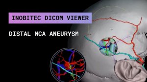 Дистальная аневризма МЦА: клипирование/деконструкция + микроанастомоз STA