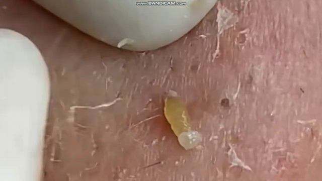Черные точки Чистка лица