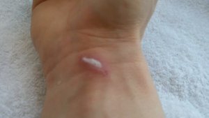 Перекись водорода шипит на ране.