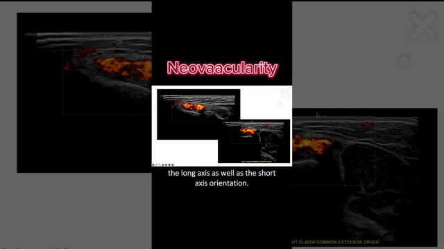 #ultrasound Guided Interventions: Cases (Tennis Elbow - Neovascularity) #fyp #sportsmedicine #sport смотреть онлайн