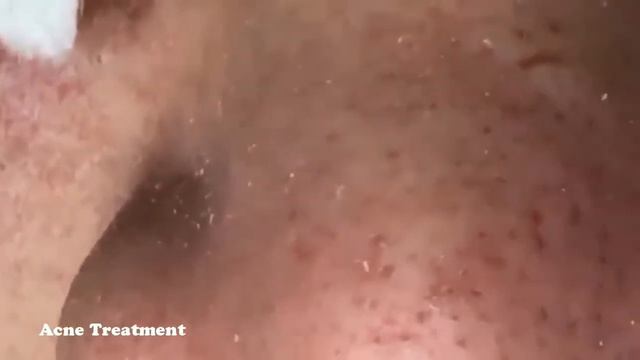 УГРИ ПРЫЩИ НА ЛИЦЕ! ДАВЛЮ Как избавиться от черноголовых ! How to get rid of blackheads4 смотреть онлайн