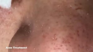 УГРИ   ПРЫЩИ НА ЛИЦЕ! ДАВЛЮ Как избавиться от черноголовых ! How to get rid of blackheads4