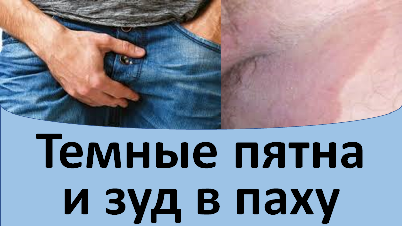 Темные пятна и зуд в паху