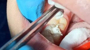 TISHGA PLOMBA QO'YISH JARAYONI. ТИШГА ПЛОМБА ҚЎЙИШ ЖАРАЁНИ.