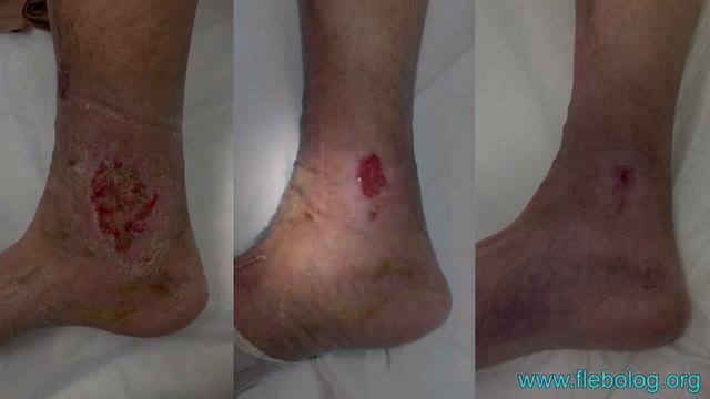 Отзыв пациента после лечения трофической язвы смотреть онлайн