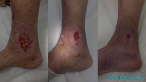Отзыв пациента после лечения трофической язвы