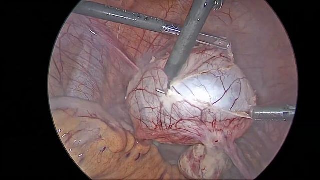 параовариальная киста смотреть онлайн