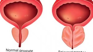 درمان پروستات در خانه و مهم ترین مواد برای پروستات | Enlarged Prostate Treatment