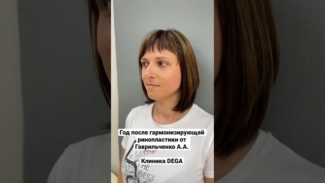 Год после пластики носа ? Пластический хирург клиники DEGA Гаврильченко А.А.