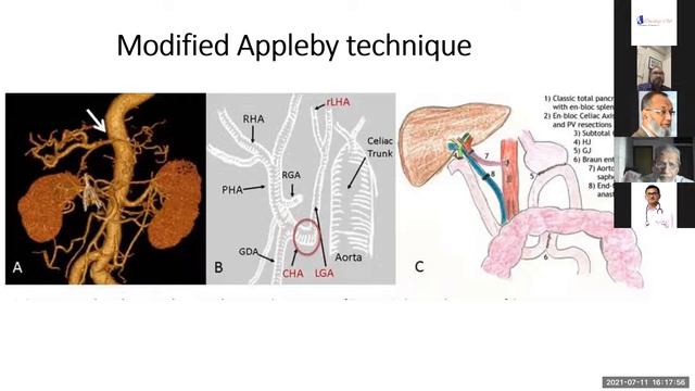 eCME on Surgical Management of pancreatic and periampullary cancer смотреть онлайн