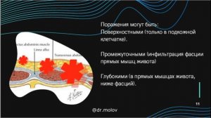 Эндометриоз болезнь с 1000 лиц (эндометриоз брюшной стенки)